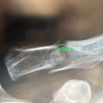 近くの外科で骨折が判明して　1